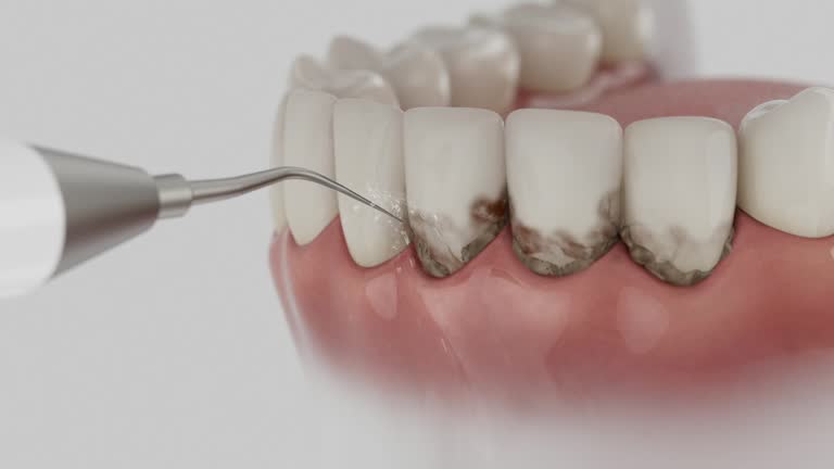 Reliable Tooth Extraction contractor in Burley, WA by Smile Center Dentistry